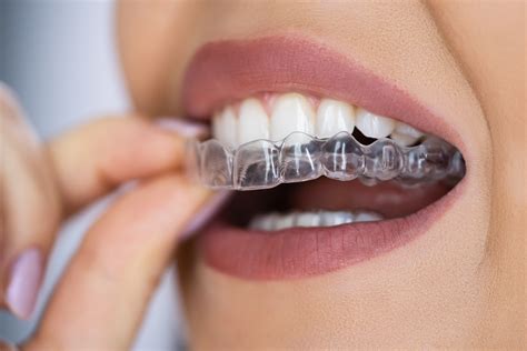 candidbestpremium.com|online teeth aligners.